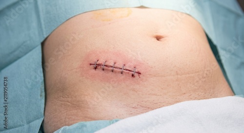 Surgical wound at the end of appendectomy operation for acute appendicitis.