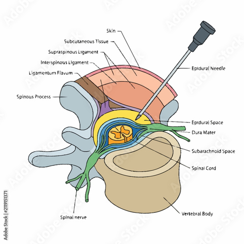Dynamic Cross Sectional Medical of Epidural Injection Showing Spinal Anatomy and Needle Placement