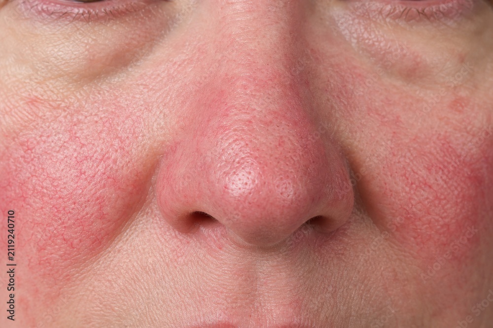 Naklejka premium Rosacea skin condition with visible capillaries on face