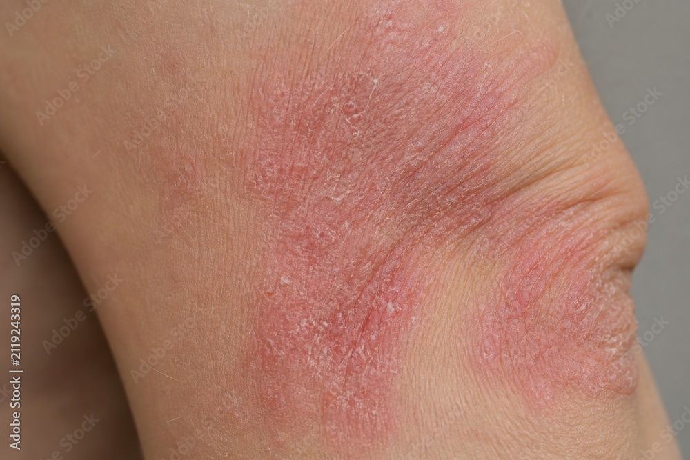 Fototapeta premium Macro of dry scaly eczema patches on human elbow