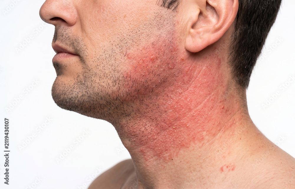 Naklejka premium Contact Dermatitis on Male Neck, Red Rash and Skin Irritation with Pustules Close Up