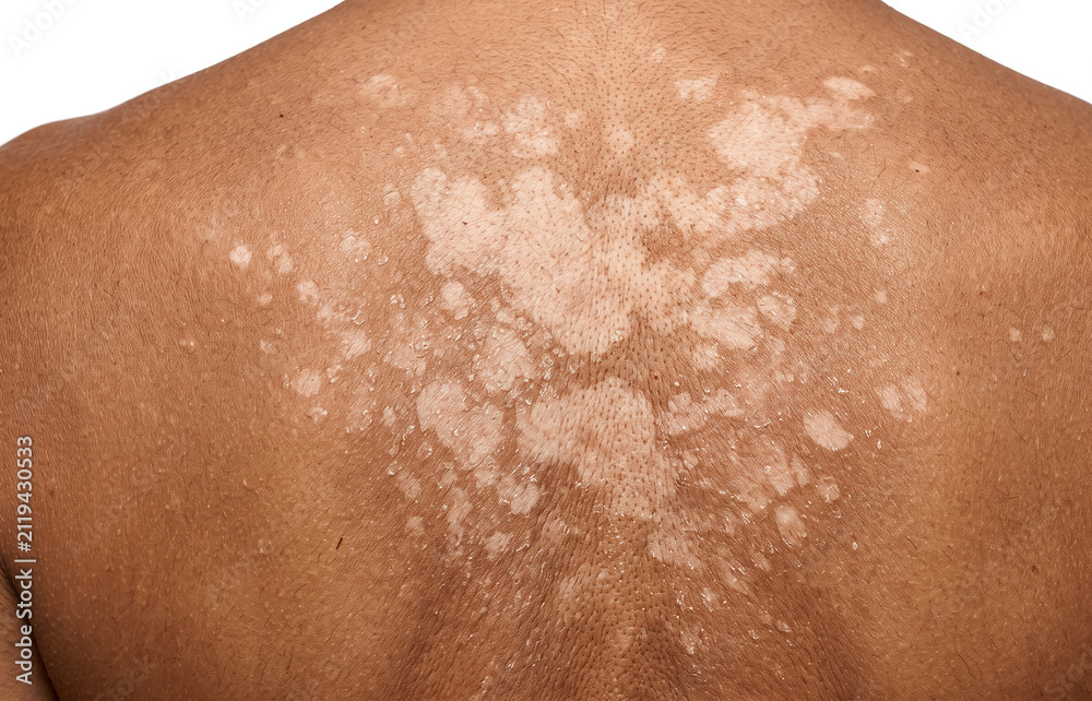 Fototapeta premium Tinea Versicolor Fungal Infection on Dark Skin Back, Hypopigmentation Dermatological Condition