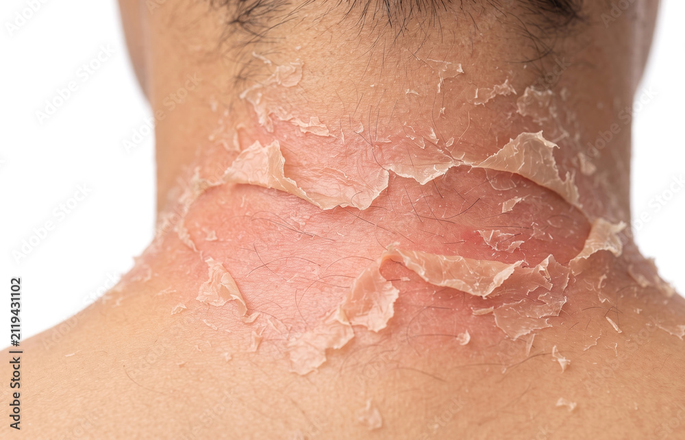 Fototapeta premium Back of human neck with severe sunburn red skin and large peeling flaking skin layers, uv sun damage concept.