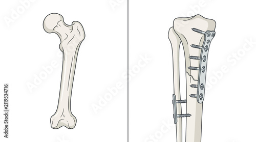 Medical illustration of human bone anatomy and orthopedic surgical plate repair