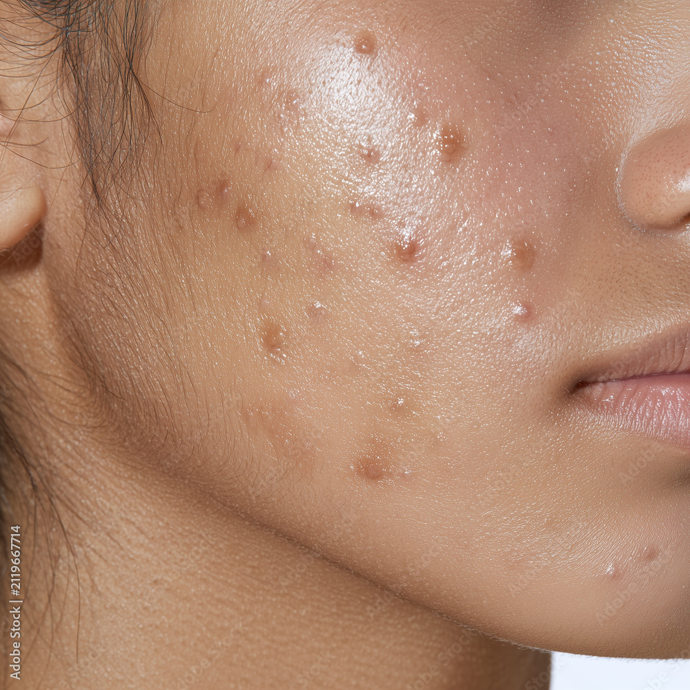 Fototapeta premium Close up of adult man cheek and jaw with acne on tan skin