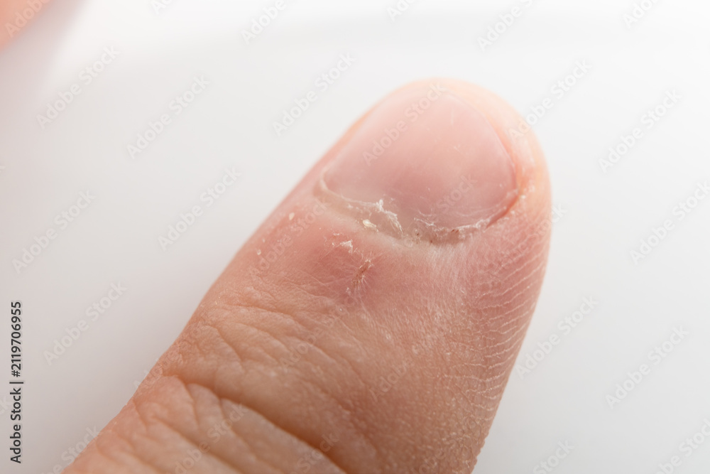 Fototapeta premium Macro close-up of a man's thumb with hangnail and dry cuticle damage isolated on white background. High quality