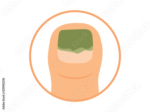 Green Nail Syndrome Clip Art