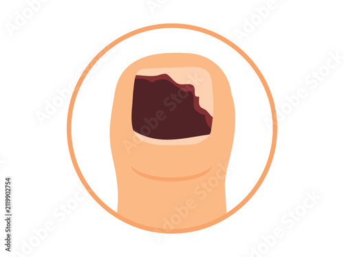 Subungual Hematoma Nail Abnormalities and Disorders