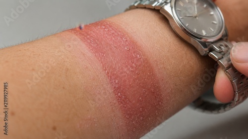 Close-up of irritated skin rash with redness and peeling on wrist underneath metal watch strap