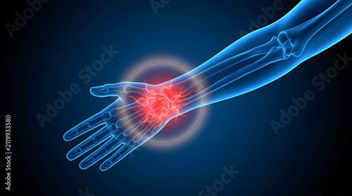 Anatomical view of human arm and hand highlighting chronic pain and injury in the wrist area