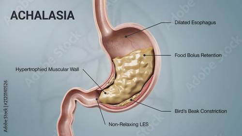 Medical illustration of achalasia showing esophagus and stomach anatomy