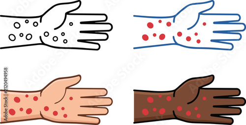 Medical vector illustration showing human hands with skin rash symptoms in different styles on white background