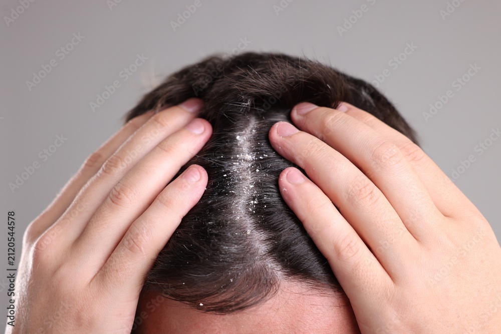 Fototapeta premium Dandruff problem. Man examining his head on grey background, closeup