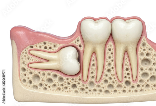 Anatomical Model of Human Jawbone Showing Impacted Wisdom Tooth Beneath Gum Tissue