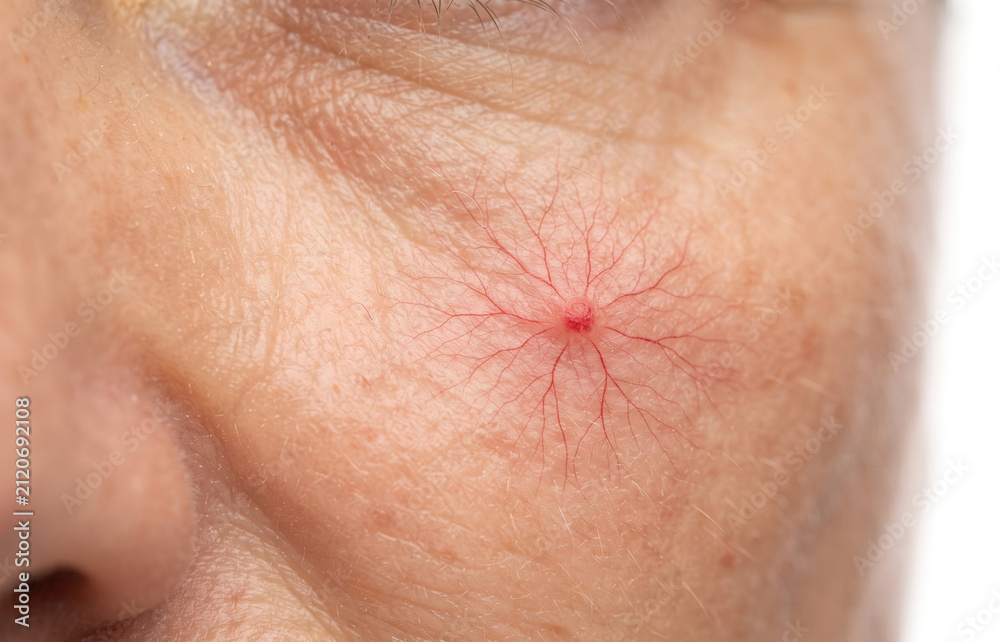 Fototapeta premium Extreme macro close up of spider angioma telangiectasia broken blood vessels on human face cheek.