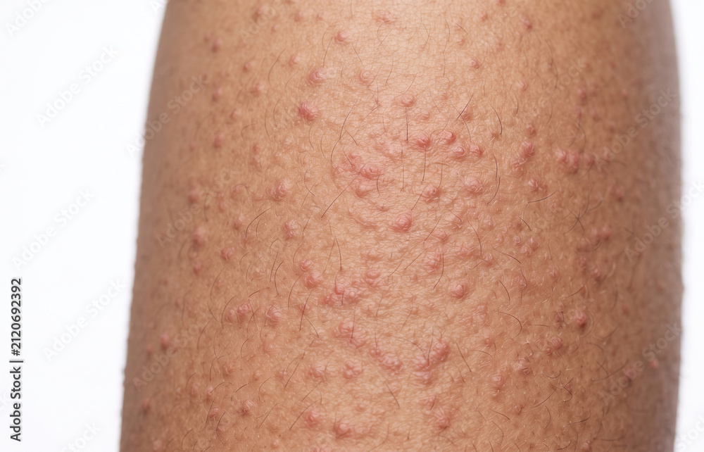 Fototapeta premium Close up of keratosis pilaris strawberry skin tiny bumps on hair follicles of human leg.