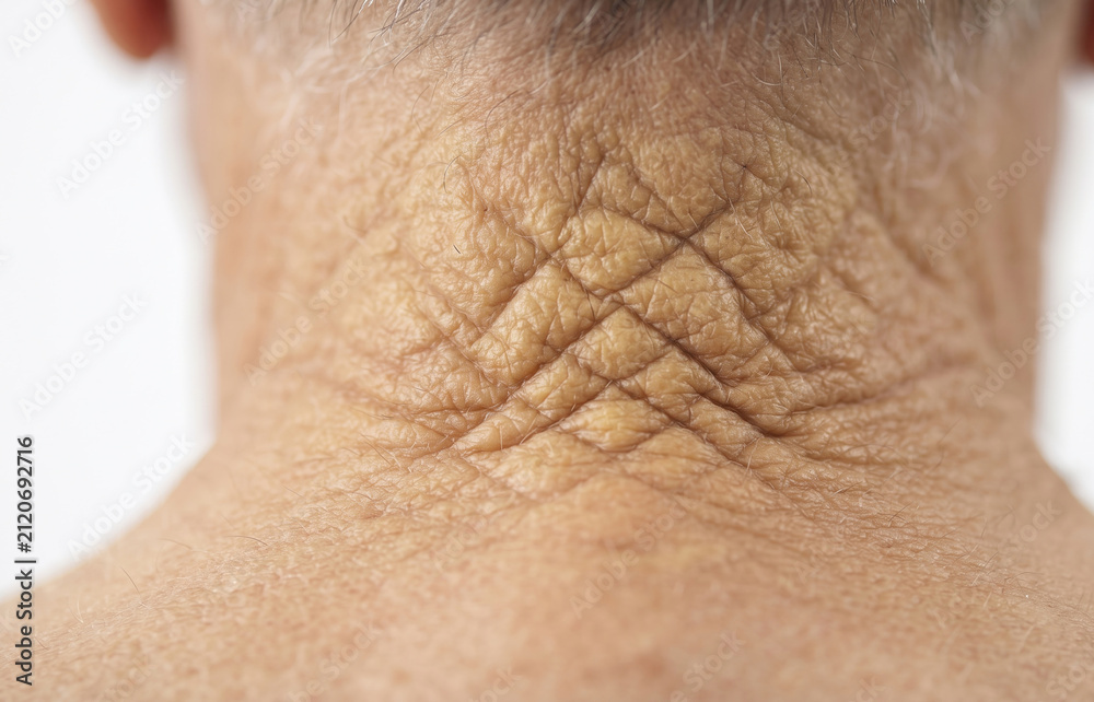 Fototapeta premium Cutis Rhomboidalis Nuchae on Senior Neck, Severe Sun Damage and Deep Wrinkles Close Up