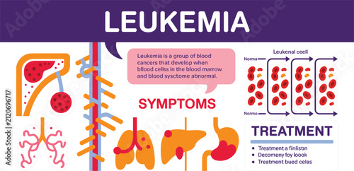 Fotografía Leukemia Medical Infographic Illustrating Blood Cancer, Abnormal White Blood Cel