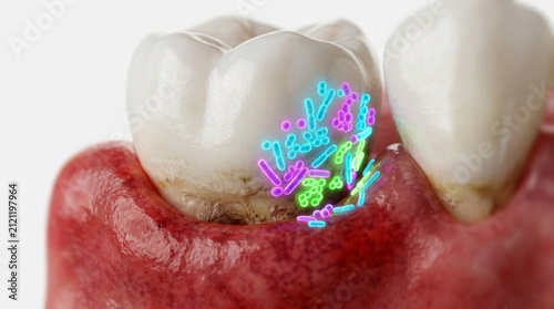 Dental illustration showing gum disease and plaque buildup on teeth.