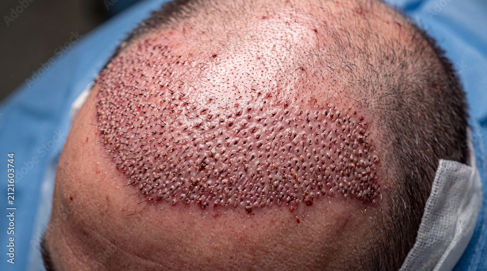Naklejka premium Detailed view of a bald scalp post hair restoration procedure with visible micro-channels and some blood spots