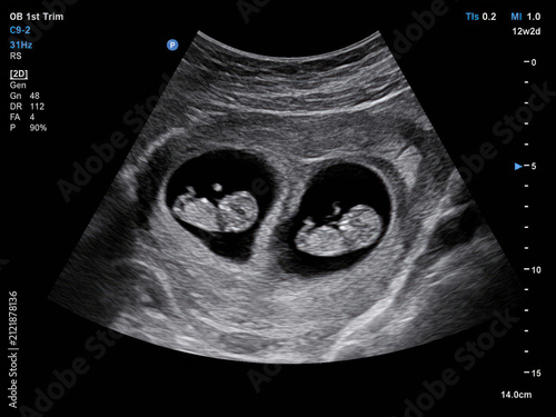 Twin Pregnancy Ultrasound Showing Two Fetuses in First Trimester