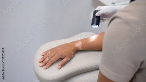 Vitiligo Clinical Assessment of Patient Hand Using Noninvasive Skin Examination Device in Dermatology Clinic
