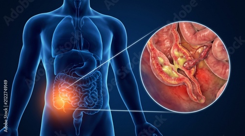 3D Medical Illustration of Appendicitis Showing Inflamed Appendix and Pus within the Human Digestive System