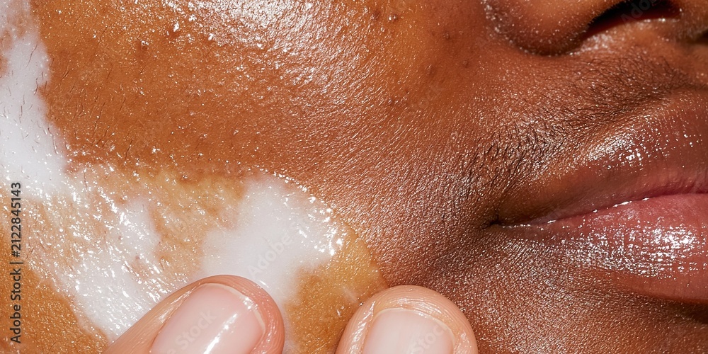 Fototapeta premium Extreme close up of brown skin with vitiligo patches being moisturized with a white cream for skincare and inclusivity concepts