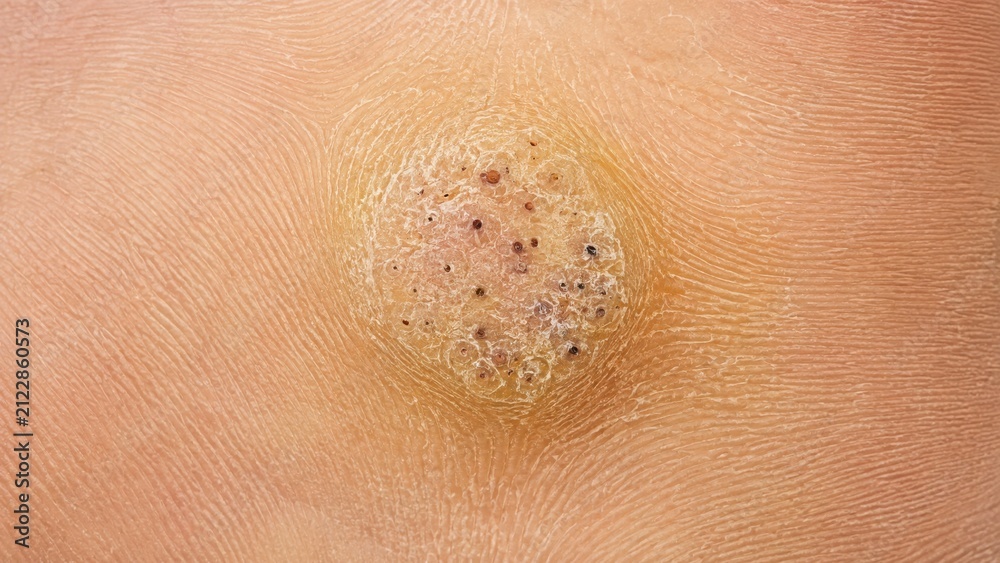 Fototapeta premium Clinical macro of plantar wart on foot sole