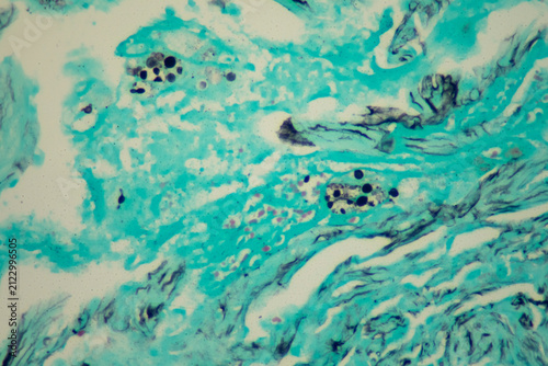 Foto Medical themes: Microscopic view of Pulmonary Paracoccidioidomycosis