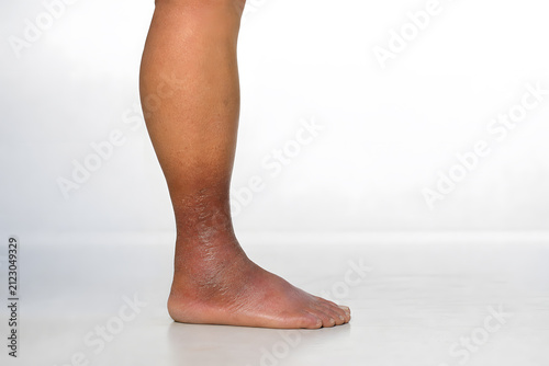 Side profile of leg with lipodermatosclerosis and skin fibrosis