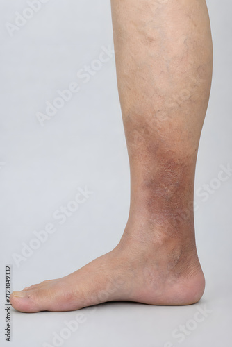 Venous eczema with dry scaly skin on lower leg