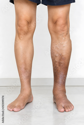 Asymmetric bilateral chronic venous insufficiency in lower legs