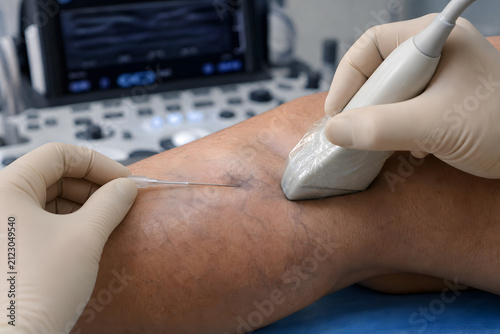 Close up of ultrasound guided sclerotherapy injection
