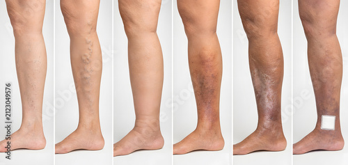 Six stages of chronic venous disease progression in legs