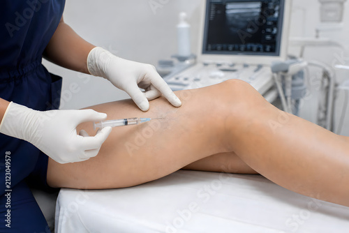 Clinician performing foam sclerotherapy on varicose vein