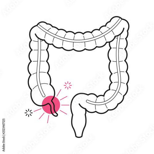 Appendicitis Pain Vector Illustration with Inflamed Human Appendix Anatomy Design