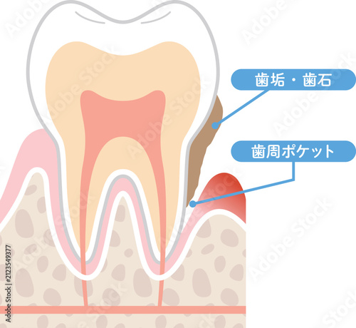 歯周炎の断面図　歯垢と歯周ポケット