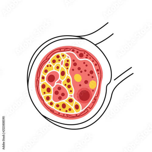 Atherosclerosis and cholesterol plaque buildup in human blood vessel cross section vector illustration