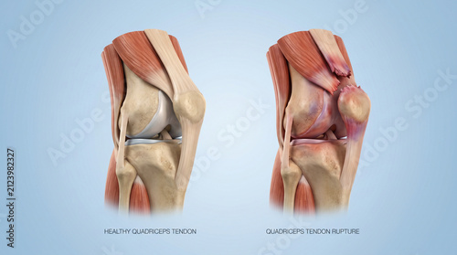 3D Medical Illustration Showing Quadriceps Tendon Rupture and Healthy Knee Anatomy
