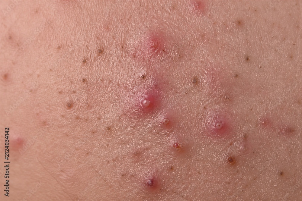 Fototapeta premium Facial skin showing inflamed acne lesions in close up