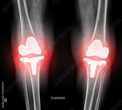 Standing anteroposterior X-ray of both knees after total knee replacement surgery, with red highlight on the prosthetic joints on black background.