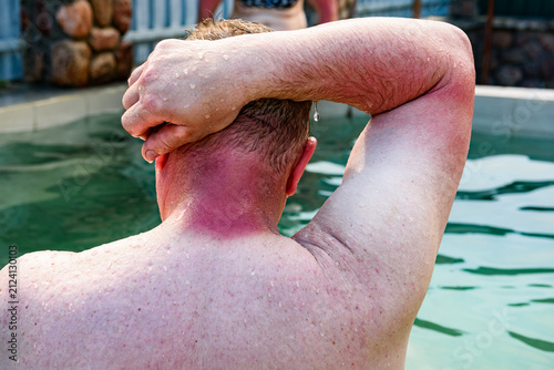 Quadro su tela Close-up of a man with red sunburn skin on his neck against the background of a pool