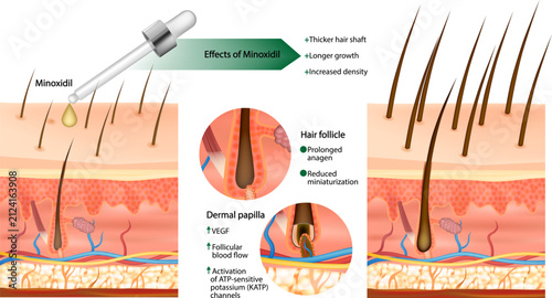 Minoxidil Mechanism of Action Hair Regrowth Medical Illustration Showing Hair Follicle Stimulation and Anagen Phase. Cross-sectional diagram of the scalp showing hair follicle stimulation