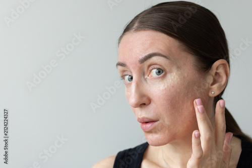 Fotografía Woman shocked how looks her face after biorevitalization.