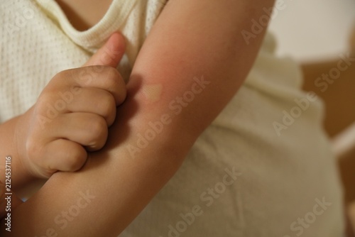 Child scratching an itchy red insect bite on the arm