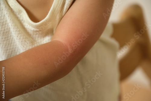 Redness and rash on the inside of a child's elbow