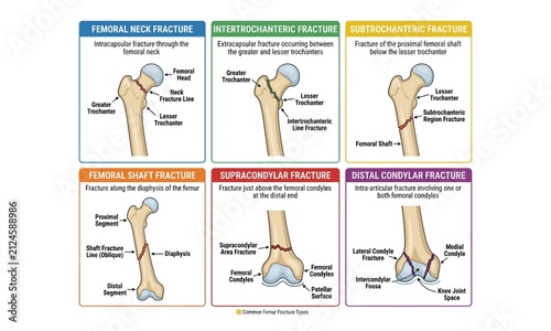 Cuadro en lienzo Diagram of femur bone fracture types and locations Vector