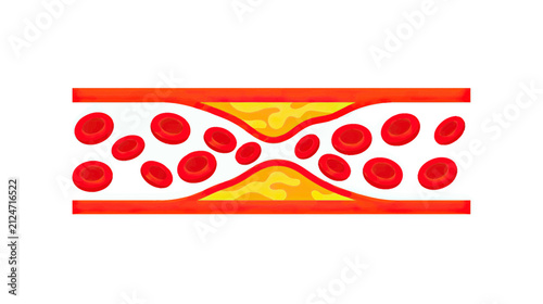 Bild auf Leinwand Artery cross-section with plaque buildup and red blood cells