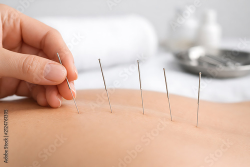 Acupuncture needles inserted into skin during alternative therapy treatment close up